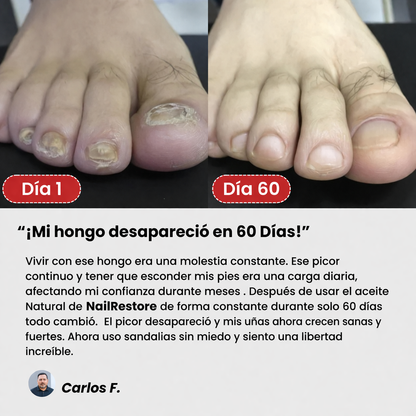 NailRestore™ | Elimina el Hongo y Recupera tus Uñas